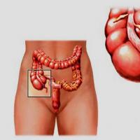 How appendicitis manifests itself during pregnancy and how to distinguish its first manifestations in the early and late stages: symptoms, clinic, treatment and operations Where is appendicitis in pregnant women